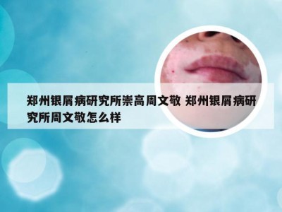 郑州银屑病研究所崇高周文敬 郑州银屑病研究所周文敬怎么样