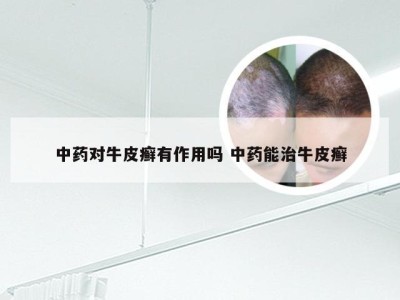 中药对牛皮癣有作用吗 中药能治牛皮癣