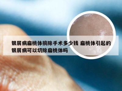 银屑病扁桃体摘除手术多少钱 扁桃体引起的银屑病可以切除扁桃体吗