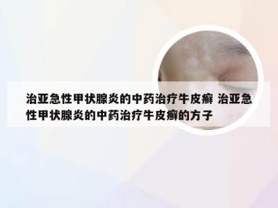 治亚急性甲状腺炎的中药治疗牛皮癣 治亚急性甲状腺炎的中药治疗牛皮癣的方子