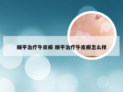 顺平治疗牛皮癣 顺平治疗牛皮癣怎么样