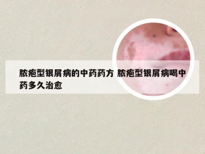 脓疱型银屑病的中药药方 脓疱型银屑病喝中药多久治愈
