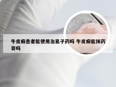 牛皮癣患者能使用治虱子药吗 牛皮癣能抹药膏吗
