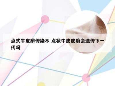 点式牛皮癣传染不 点状牛皮皮癣会遗传下一代吗