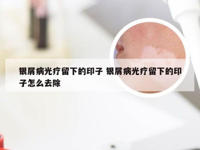 银屑病光疗留下的印子 银屑病光疗留下的印子怎么去除
