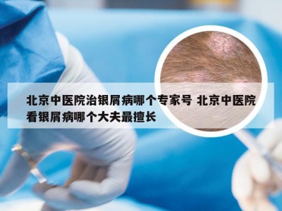 北京中医院治银屑病哪个专家号 北京中医院看银屑病哪个大夫最擅长