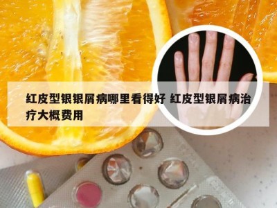 红皮型银银屑病哪里看得好 红皮型银屑病治疗大概费用
