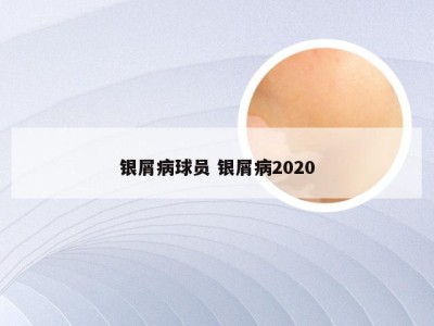 银屑病球员 银屑病2020