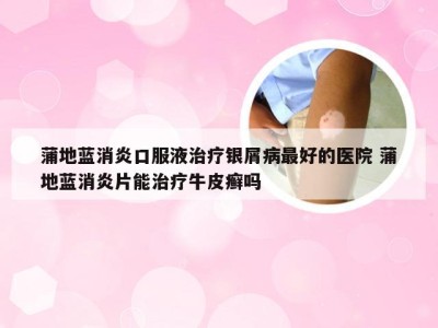 蒲地蓝消炎口服液治疗银屑病最好的医院 蒲地蓝消炎片能治疗牛皮癣吗