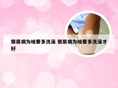 银屑病为啥要多洗澡 银屑病为啥要多洗澡才好