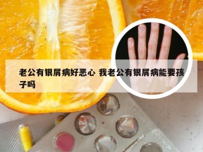 老公有银屑病好恶心 我老公有银屑病能要孩子吗