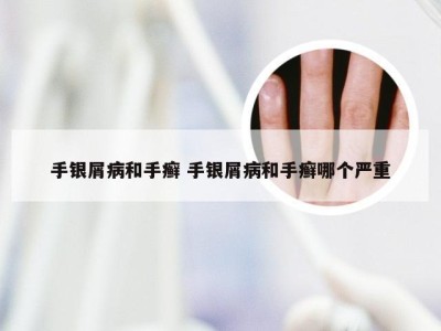 手银屑病和手癣 手银屑病和手癣哪个严重