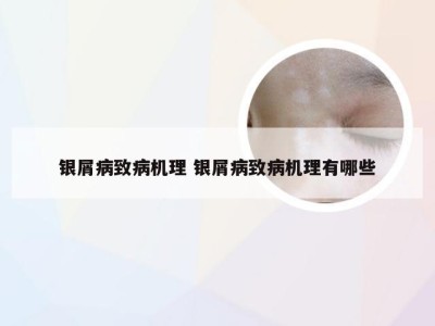 银屑病致病机理 银屑病致病机理有哪些