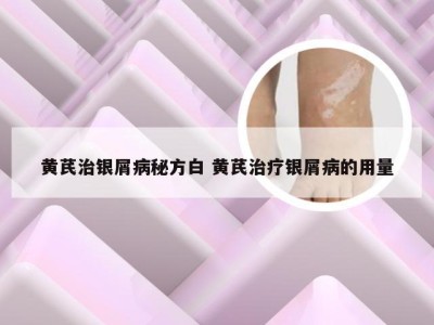 黄芪治银屑病秘方白 黄芪治疗银屑病的用量