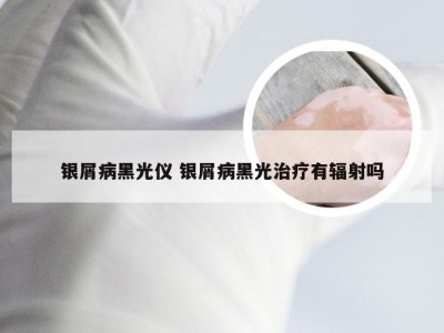 银屑病黑光仪 银屑病黑光治疗有辐射吗