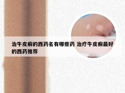 治牛皮癣的西药名有哪些药 治疗牛皮癣最好的西药推荐