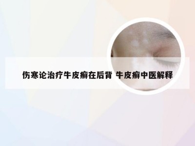 伤寒论治疗牛皮癣在后背 牛皮癣中医解释