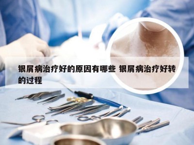 银屑病治疗好的原因有哪些 银屑病治疗好转的过程