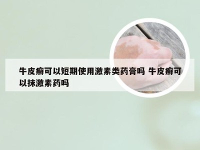 牛皮癣可以短期使用激素类药膏吗 牛皮癣可以抹激素药吗