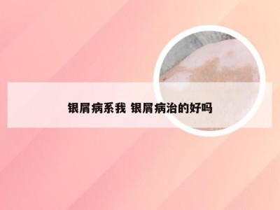 银屑病系我 银屑病治的好吗