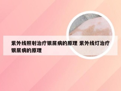 紫外线照射治疗银屑病的原理 紫外线灯治疗银屑病的原理