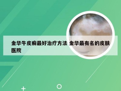 金华牛皮癣最好治疗方法 金华最有名的皮肤医院