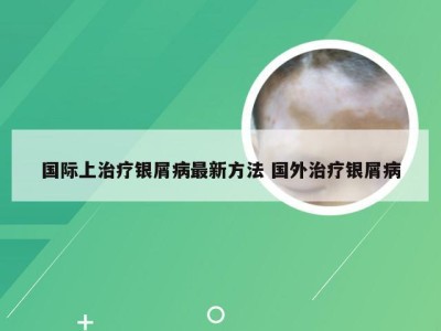 国际上治疗银屑病最新方法 国外治疗银屑病