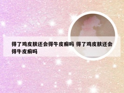 得了鸡皮肤还会得牛皮癣吗 得了鸡皮肤还会得牛皮癣吗