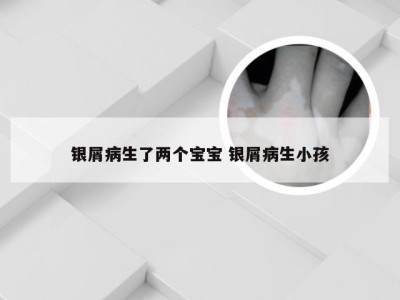 银屑病生了两个宝宝 银屑病生小孩