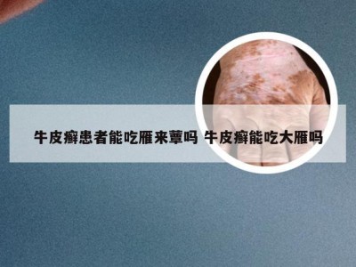 牛皮癣患者能吃雁来蕈吗 牛皮癣能吃大雁吗