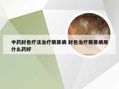 中药封包疗法治疗银屑病 封包治疗银屑病用什么药好