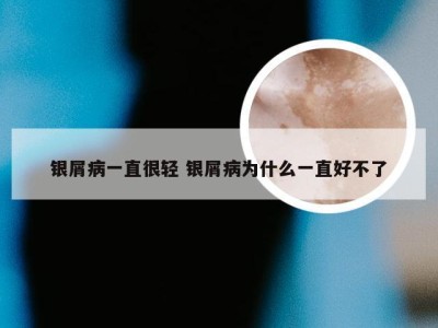 银屑病一直很轻 银屑病为什么一直好不了