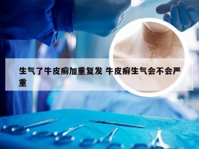 生气了牛皮癣加重复发 牛皮癣生气会不会严重