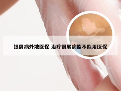 银屑病外地医保 治疗银屑病能不能用医保
