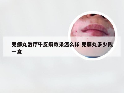 克癣丸治疗牛皮癣效果怎么样 克癣丸多少钱一盒