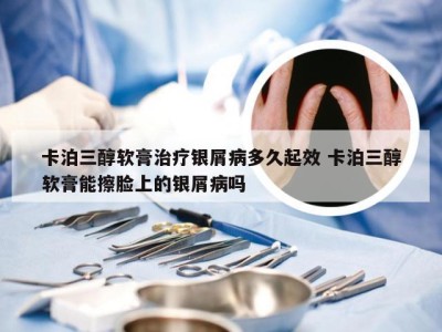 卡泊三醇软膏治疗银屑病多久起效 卡泊三醇软膏能擦脸上的银屑病吗