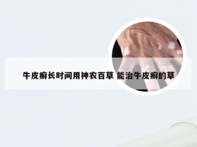 牛皮癣长时间用神农百草 能治牛皮癣的草