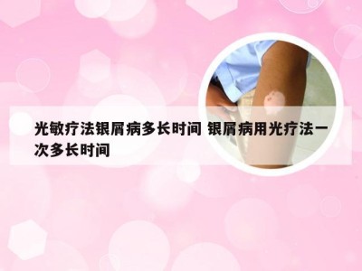 光敏疗法银屑病多长时间 银屑病用光疗法一次多长时间