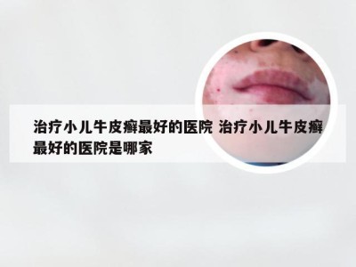 治疗小儿牛皮癣最好的医院 治疗小儿牛皮癣最好的医院是哪家