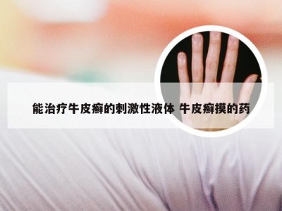 能治疗牛皮癣的刺激性液体 牛皮癣摸的药