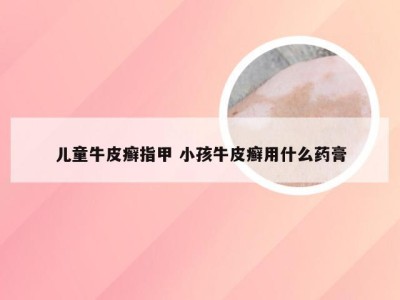 儿童牛皮癣指甲 小孩牛皮癣用什么药膏