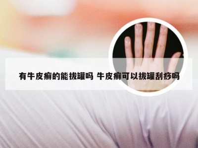 有牛皮癣的能拔罐吗 牛皮癣可以拔罐刮痧吗