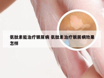 氨肽素能治疗银屑病 氨肽素治疗银屑病效果怎样