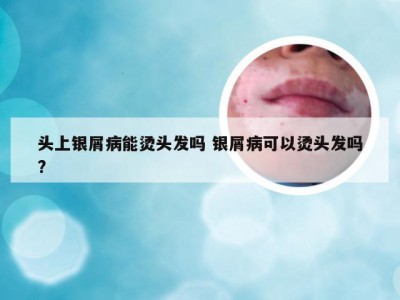 头上银屑病能烫头发吗 银屑病可以烫头发吗?