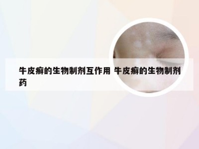 牛皮癣的生物制剂互作用 牛皮癣的生物制剂药