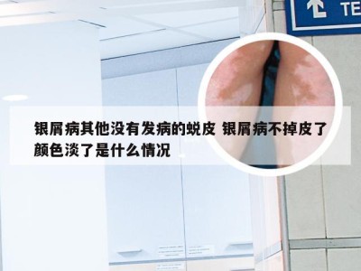 银屑病其他没有发病的蜕皮 银屑病不掉皮了颜色淡了是什么情况