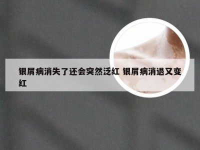 银屑病消失了还会突然泛红 银屑病消退又变红
