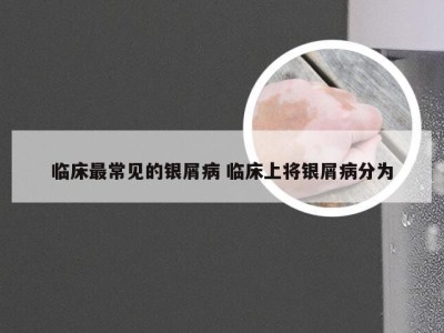 临床最常见的银屑病 临床上将银屑病分为