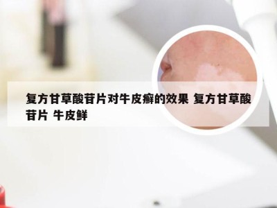复方甘草酸苷片对牛皮癣的效果 复方甘草酸苷片 牛皮鲜