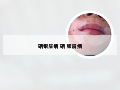 硒银屑病 硒 银屑病